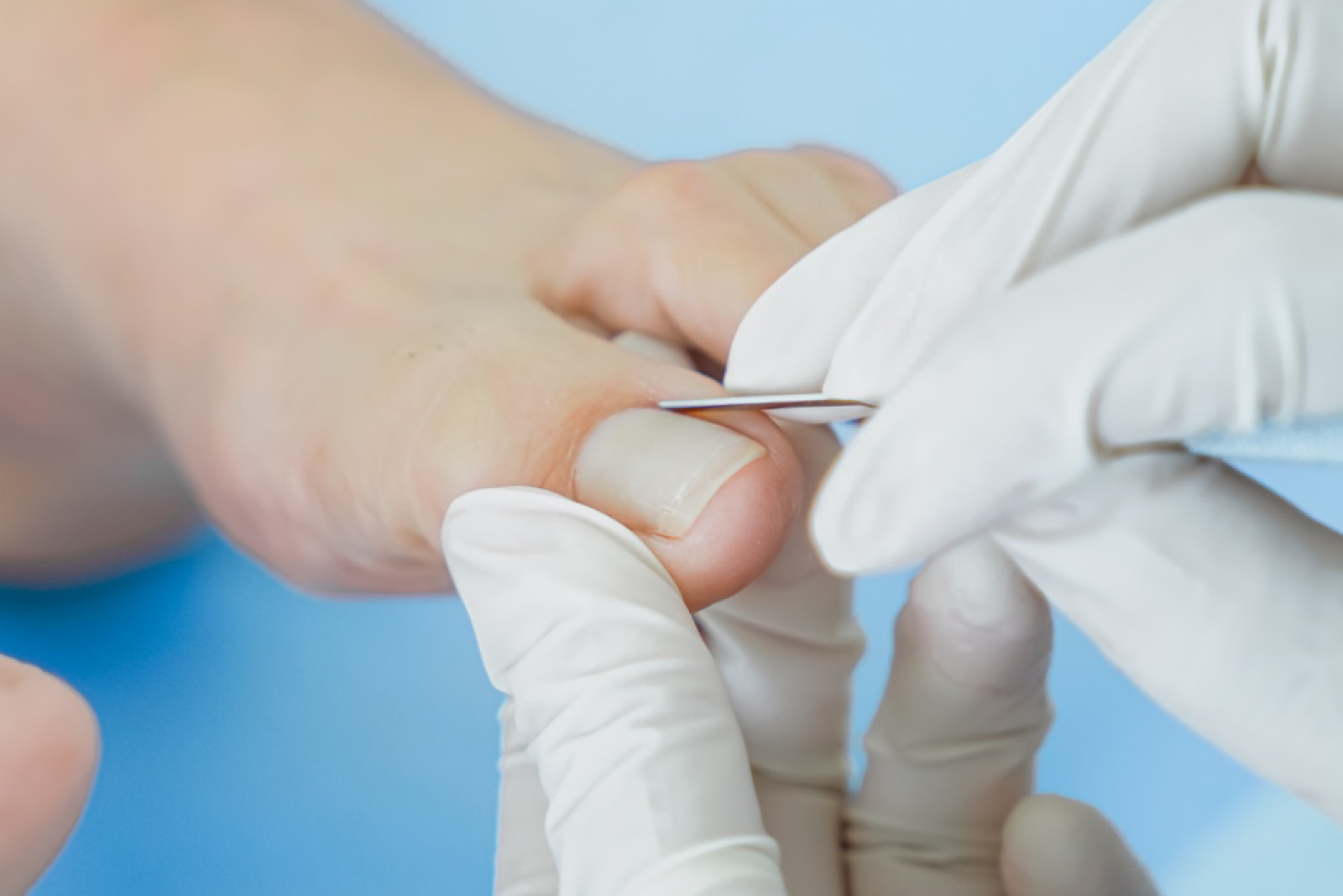 Pedicure correctivo realizado por una especialista